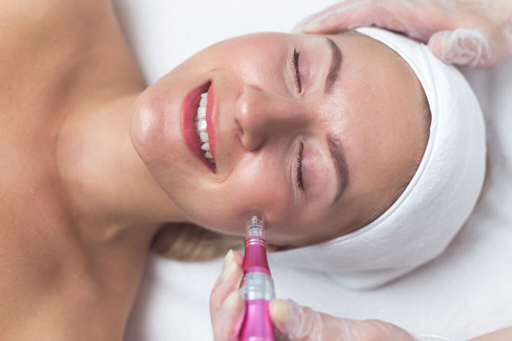 Microneedling at SKIn4U med spa